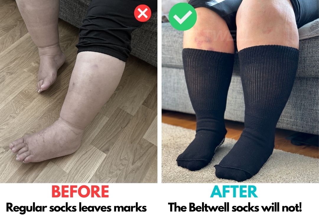 Beltwell® - The Oversized Circulation Socks For Swollen Legs & Feet (2 pairs)